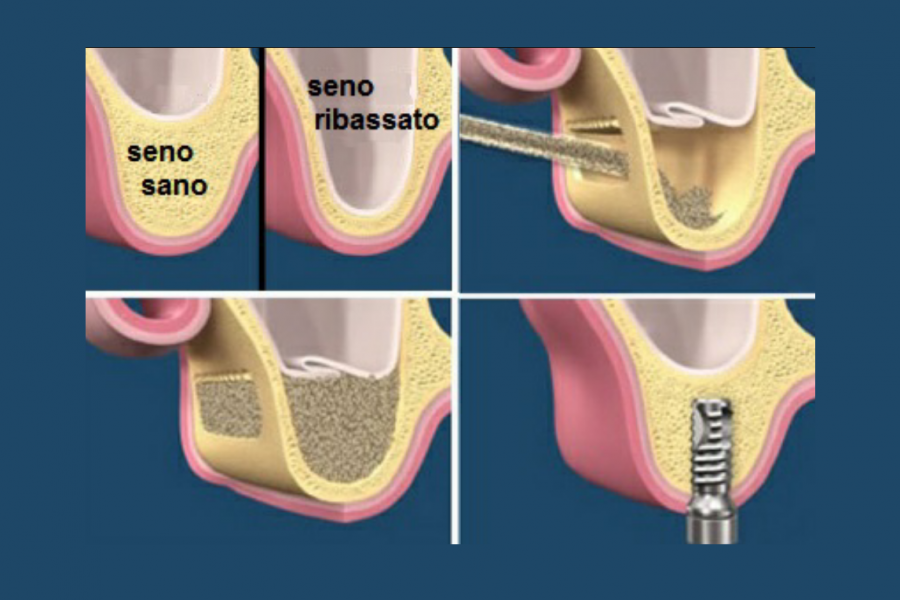  Rigenerazione Ossea autologa PRF